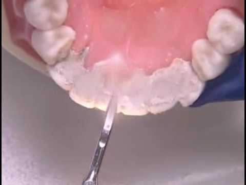 scaling calculus on anterior lingual teeth youtube dental calculus
