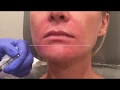 Lip filler treatment  dr saluja  dr novo