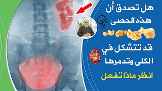 تعليمات لاينتبه لها أحد تحمي الكلى وتمنع تشكل الحصوات قل وداعا لحصى الكلى وتعلم تنظيف الكلى من الحصى