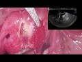 LUMWA Lap And Usg Guided Microwave Ablation For Uterine Adenomyosis LUMWA Lap And Usg Guided Microwave Ablation For Uterine Adenomyosis