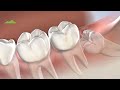 Post-Operative Instructions: Wisdom Teeth Removal | Provo UT | Utah Surgical Arts