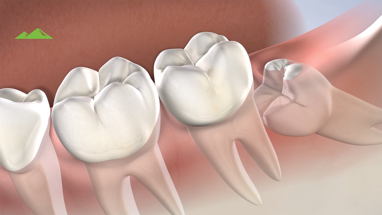 ⁣Post-Operative Instructions: Wisdom Teeth Removal | Provo UT | Utah Surgical Arts