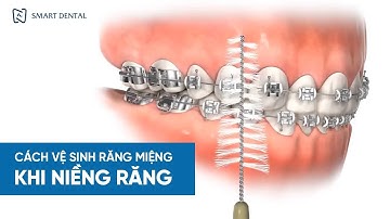 Hướng dẫn cách vệ sinh răng miệng khi niềng răng chuẩn & chi tiết | Nha khoa Smart