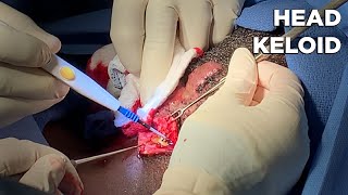 Head Keloid Removal - Dr. Michael Jones | Lexington Plastic Surgeons