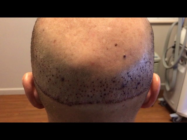 FUT Scar Correction with FUE Grafts One Day Out