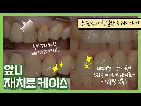 앞니 레진과 <strong>크라운</strong> 재치료