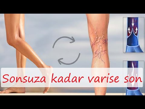 Varisler ve venöz yetmezlik | Varisten %100 nasıl kurtulduk bu videoda anlatıyoruz | Varis tedavisi