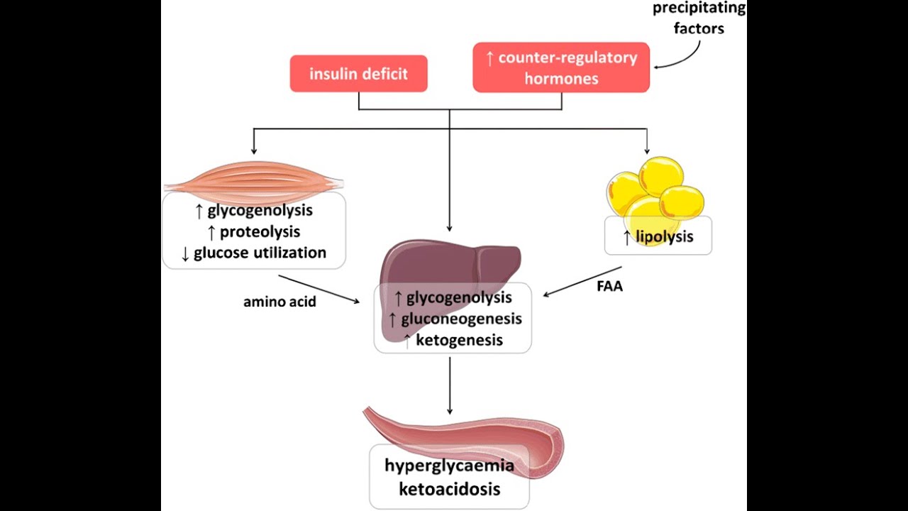 Diabetic ketoacidosis DKA As an Acute Complications of Diabetes Mellitus
