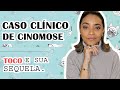 CINOMOSE. CASO CLÍNICO - TOCO e sua sequela.