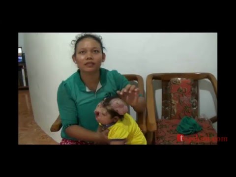Video: Anak Yang Dilahirkan Dengan Otak Di Luar Berpaut Pada Kehidupan VIDEO