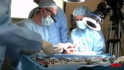 XiVE Immediate loading in the edentulous mandible