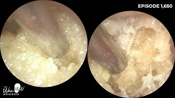 1,650 - Bleached White Ear Wax Removal