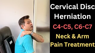 Cervical Disc Herniation, C5-C6, Neck and Arm Pain, Cervical Symptoms, Cervical Radiculopathy