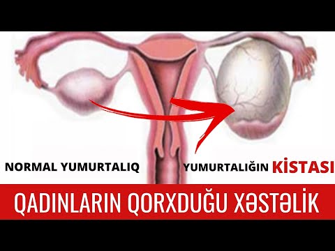 Video: Yumurtalıq kistasının yırtılması necə hiss olunur?