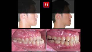 Nonsurgical Treatment of Skeletal Asymmetrical Class III Malocclusion｜【Chris Chang Ortho】CC765