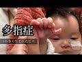 【多指症】【生後3ヶ月】ハンドリガードが始まった!4pマイナス症候群のピナ