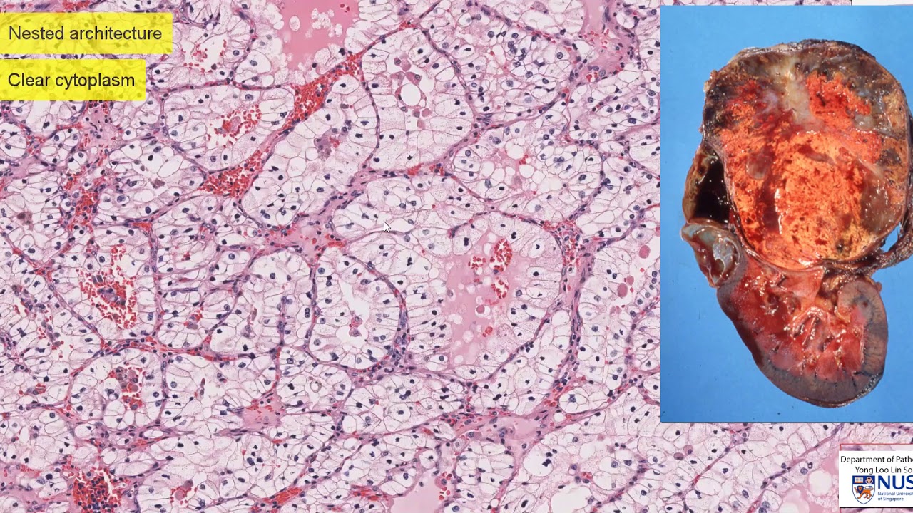 Renal cell carcinoma II: Type and Grade
