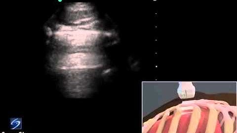 3D How to  EFAST   Lung Sliding Detection with Phased Array Transducer   YouTube