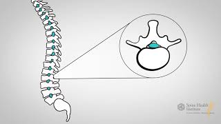 What Is Lumbar Stenosis?