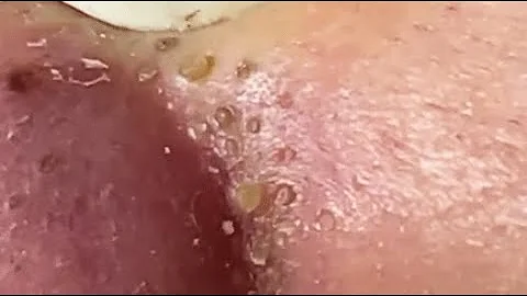 TOP OF BLACKHEADS REMOVAL FROM THE NOSE 😨 #relaxing  #blackheads