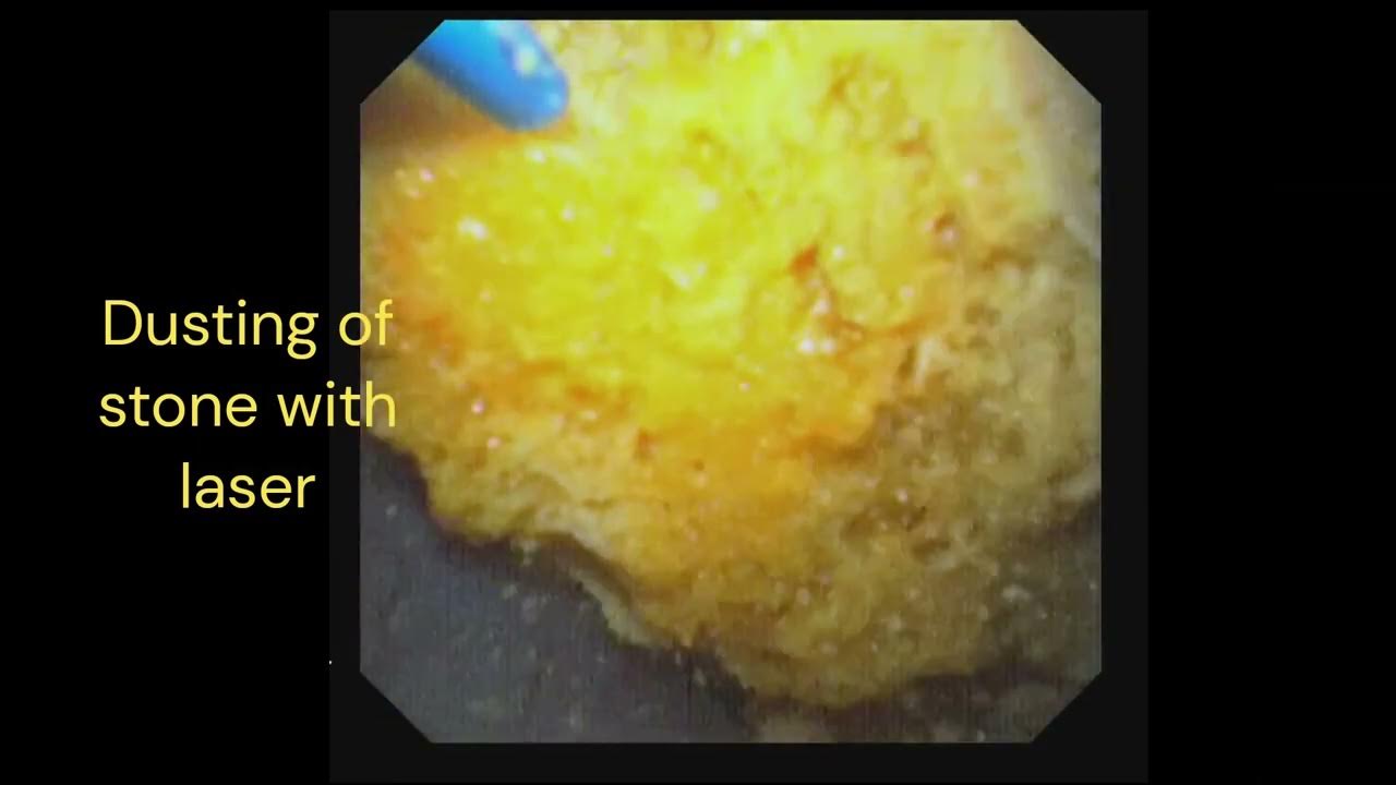 Rirs retrograde intra renal surgery with laser in 1 year old child