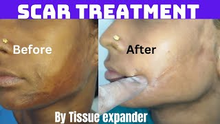 Scar correction with tissue expander| Treatment of scar using tissue expander - Result after 4 month