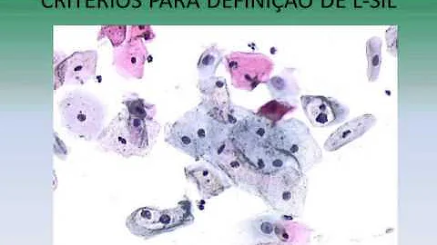 Quais os graus de displasia?