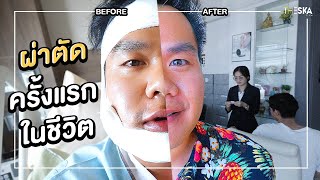 [ENG SUB] Braces Journey EP.2 Jaw Surgery Before Braces... How Much Do I Change?