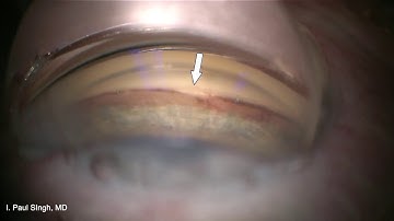 MIGS - Combining iStent Inject with Viscodilation Using the OMNI Device - Dr. Paul Singh, MD