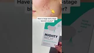 If you have early-stage blemishes, you NEED these products!