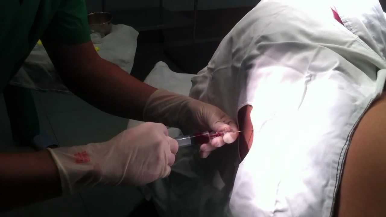 radiculopathy after blood patch radiculopathy after blood patch
