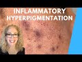 TREATMENTS FOR INFLAMMATORY HYPER-PIGMENTATION | AGE SPOTS