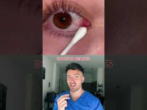 Doctors Explains "Eye Strings"