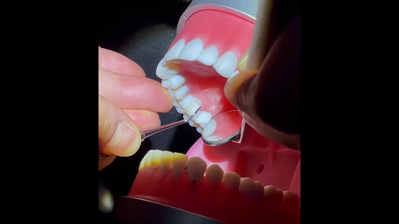 Sickle Scaler - UR Posterior