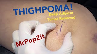 Deep Adipose Tissue Fatty Tumor Removed.pops Out Into My Hand.tender Bump Increasing In Size Is Gone