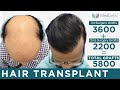 Best hair transplant results in delhi india  best hair transplant clinic in delhi  medlinks