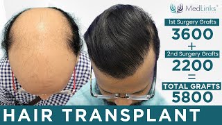 💥Best Hair Transplant Results in Delhi, India | Best Hair Transplant Clinic in Delhi | Medlinks