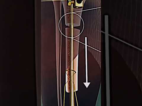Leg Rod Placement 3D Animated Medicoabdullah Shortsyoutube
