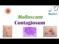 Molluscum Contagiosum (“Papules with Belly Buttons”): Risk factors, Symptoms, Diagnosis,  Treatment
