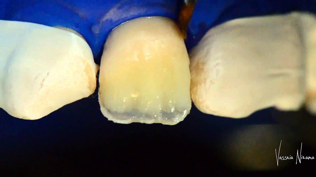 Estratificación Clase IV