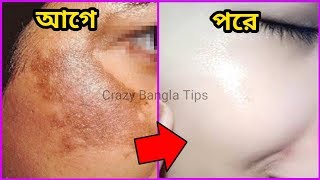 কিভাবে চিরতরে মুখ থেকে মেছতা ও মেছতার দাগ দূর করে নিতে পারবেন।মেছতা দূর করার কার্যকারী উপায়। screenshot 1