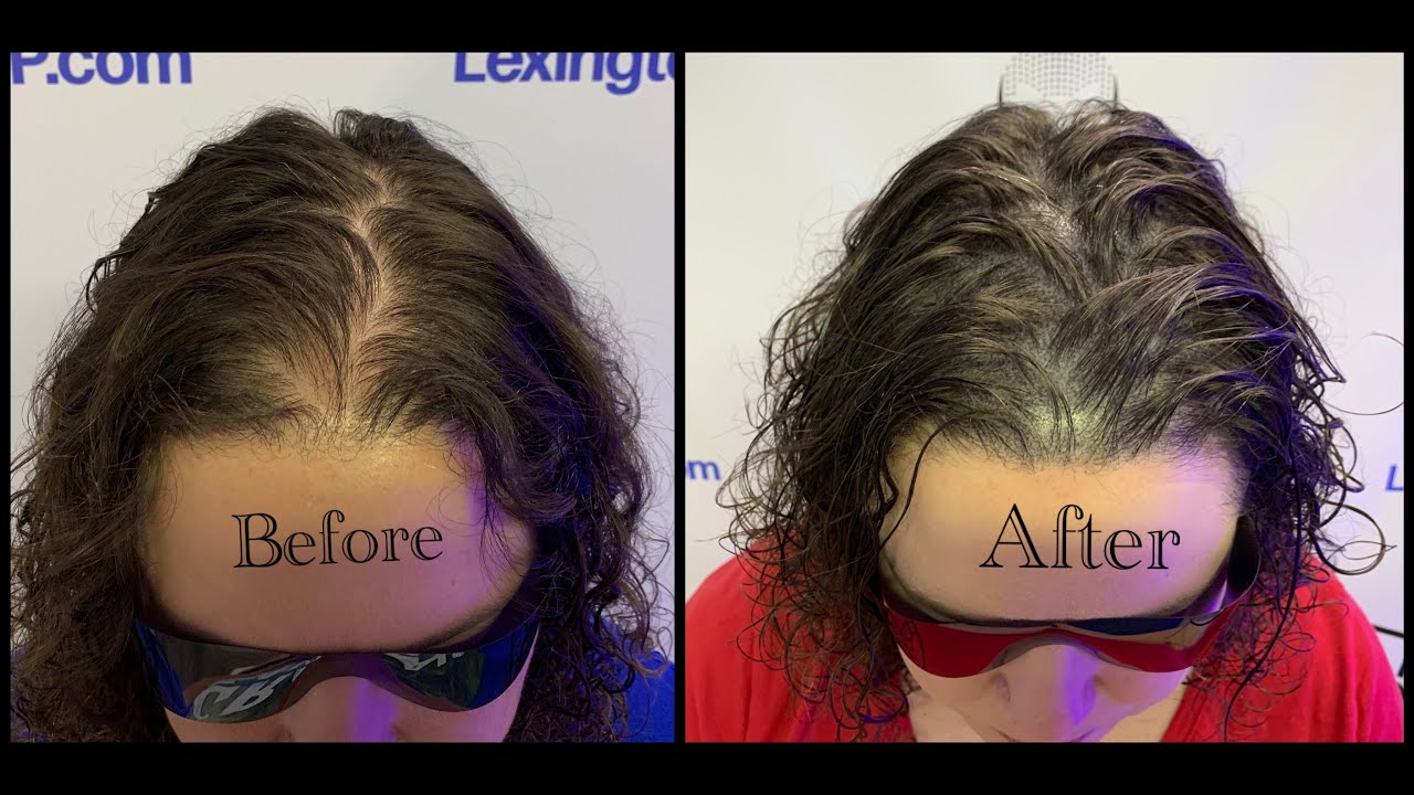 Women’s Hair Loss Treatment Lexington, KY YouTube