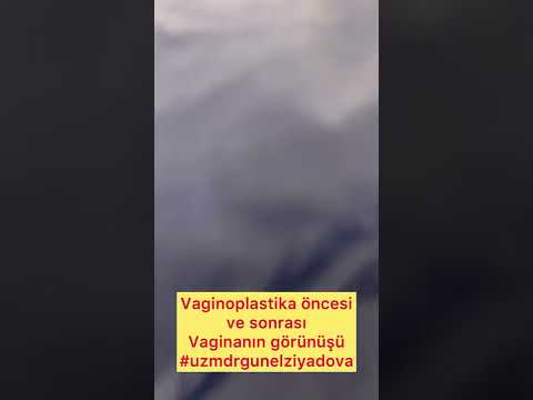 Vaginoplastika öncesi ve sonrası vagina görünüşü(vajinoplasti,vaginoplastika,genital estetik)