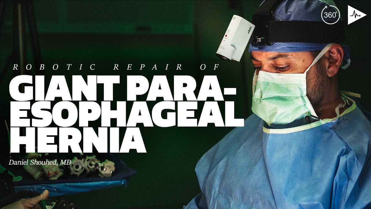 Robotic Repair of Giant Paraesophageal Hernia by Daniel Shouhed, MD