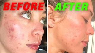 The Real Reasons You Still Have Acne | Peaches Skin Care