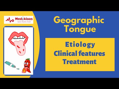 Geographic tongue (Benign Migratory Glossitis)