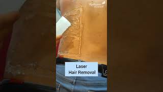 Laser Hair Removal in Pune by board approved Cosmetic Surgeon
