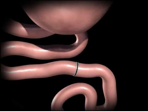 roux bypass gastric animation