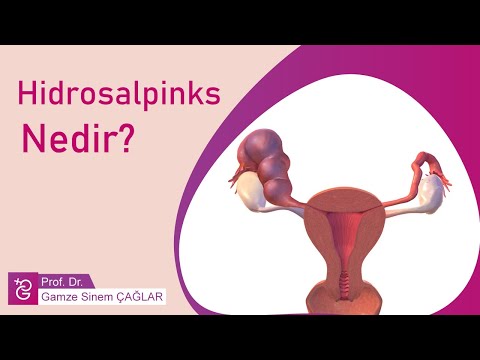 Video: Hidrosalpinks silinməlidirmi?