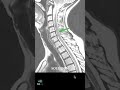 MRI - CERVICAL SPINE ARTEFACT